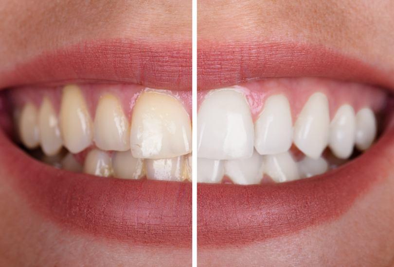 Teeth Whitening treatment dentist southport ormskirk formby