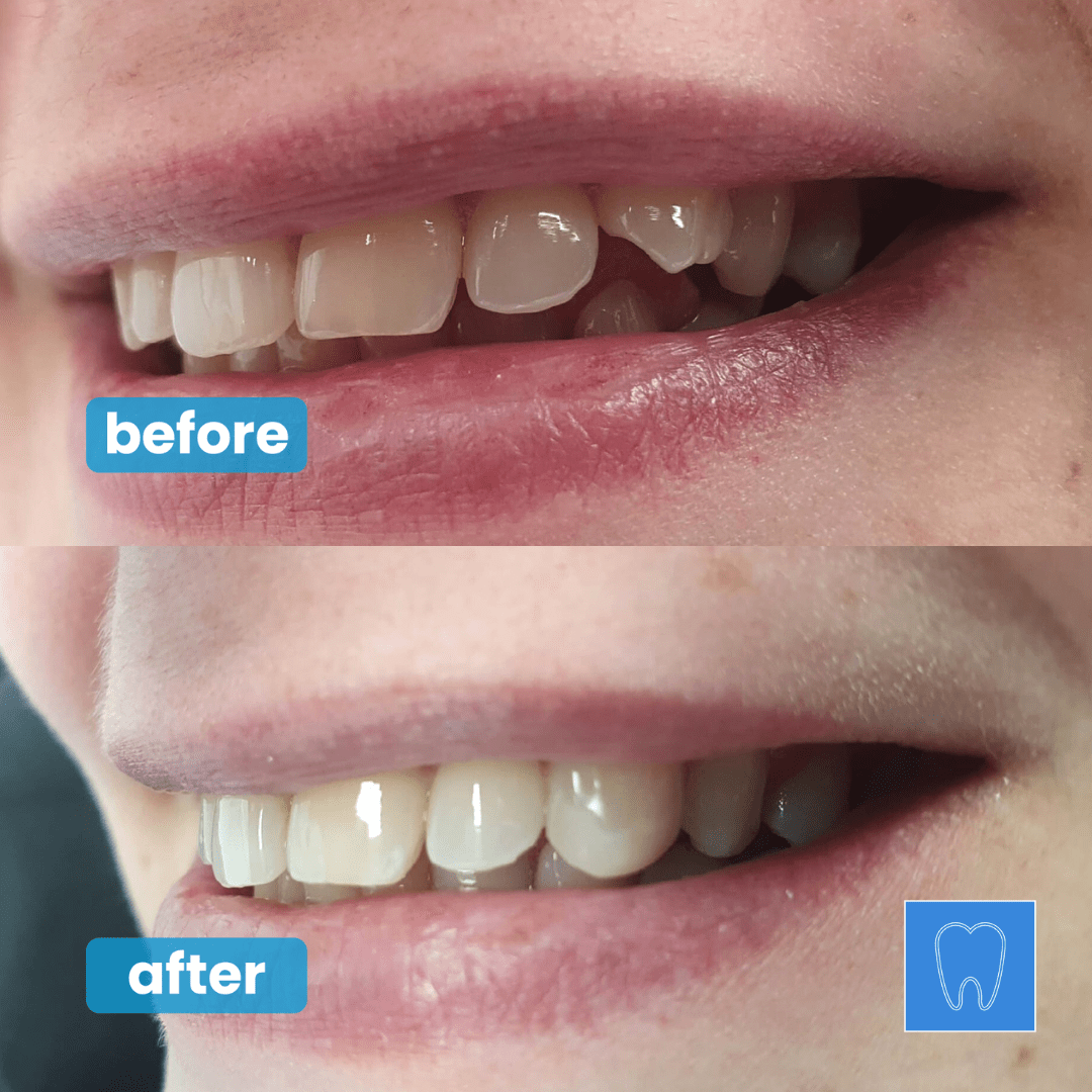 Composite Bonding Southport Formby Dental Smile Makeover