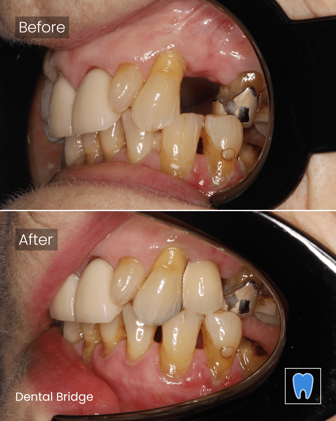 Dental Bridges